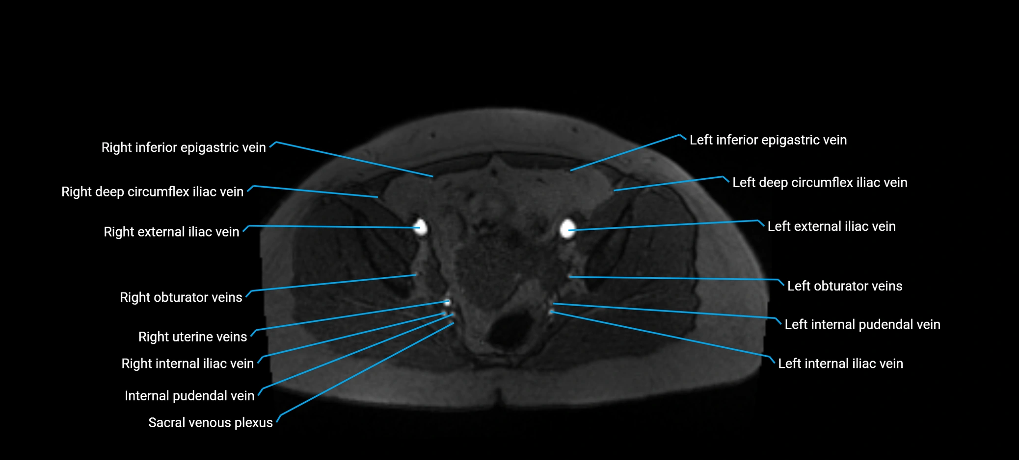 MRV abdomen pelvis & lower limb axial cross sectional anatomy labelled MRI image 161 (1).webp